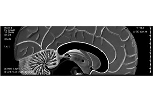 Diagnosing CNS Diseases