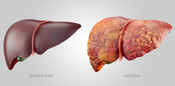 Healthy liver versus cirrhosis
