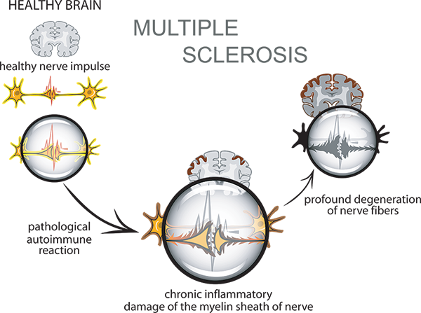 Multiple Sclerosis