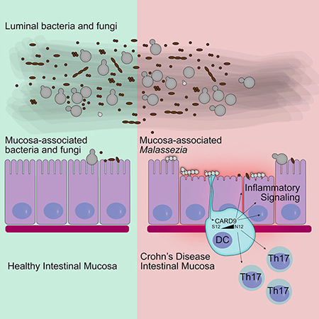 IBD Severity and Fungi in Microbiome