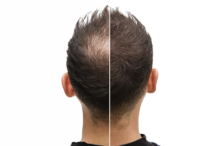 Nude Mice, Xenografts, and Treating Baldness